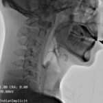 Imagem lateral de cabeza y cuello en radiologia